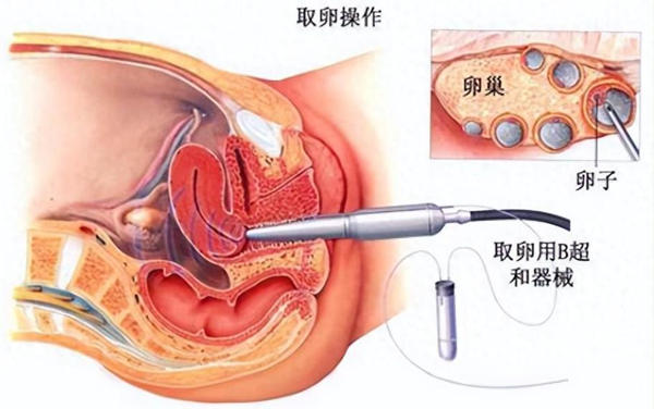 试管婴儿怎么做的全过程